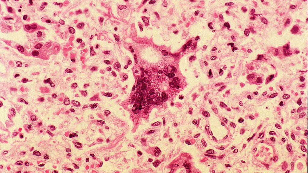 Maine Reports Its Sixth Measles Case of 2026, With Waterville Clinic Flagged as Exposure Site