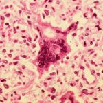Maine Reports Its Sixth Measles Case of 2026, With Waterville Clinic Flagged as Exposure Site