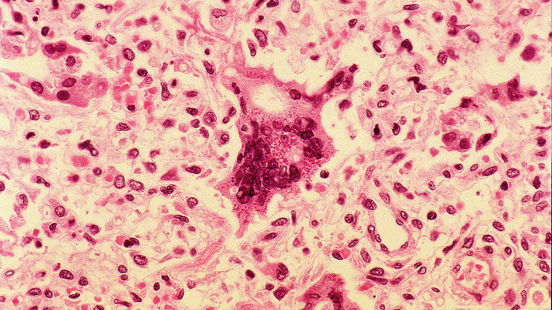 Maine Reports Its Sixth Measles Case of 2026, With Waterville Clinic Flagged as Exposure Site